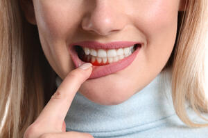 Melyek lehetnek a fogínygyulladás jelei?